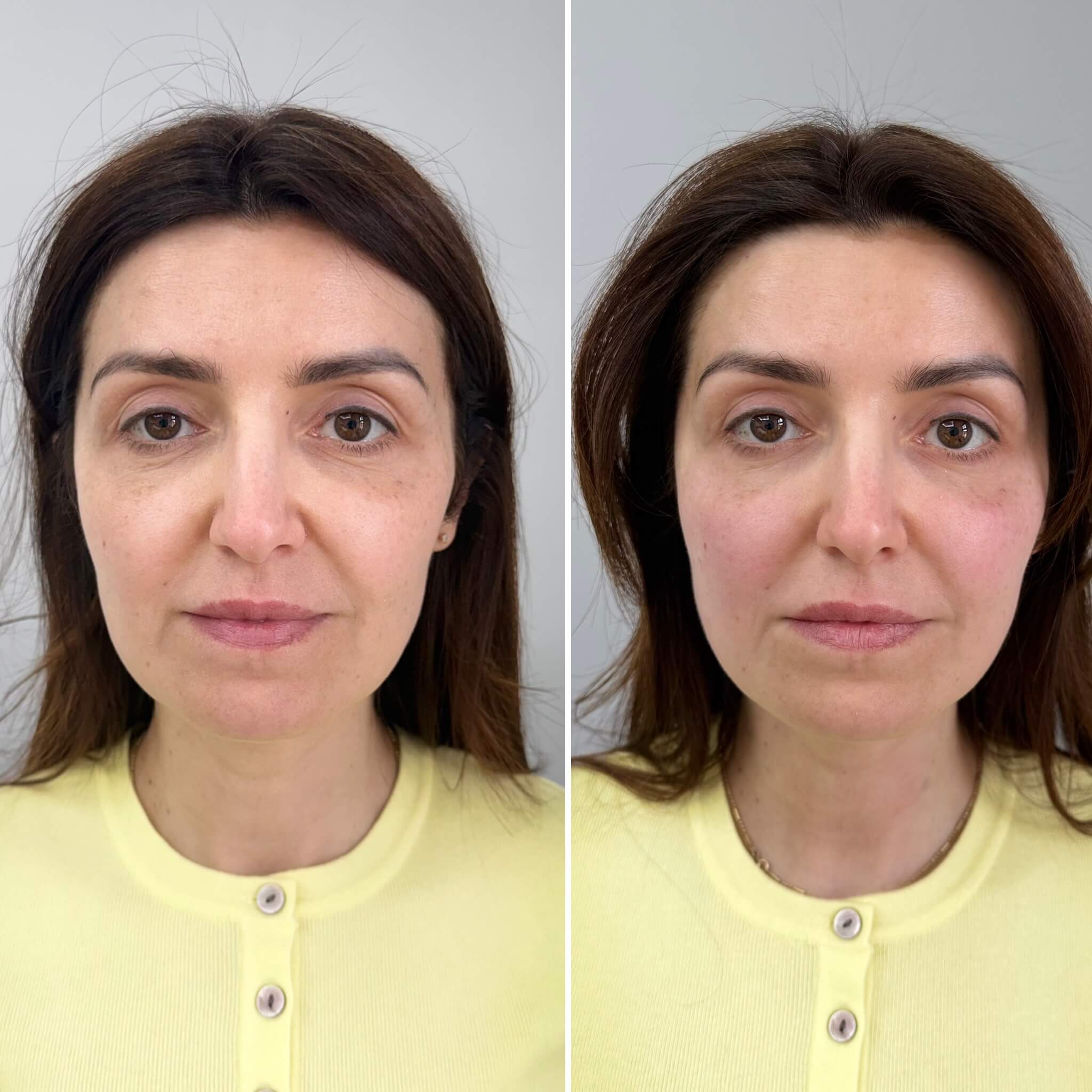 Před a po – estetická medicína